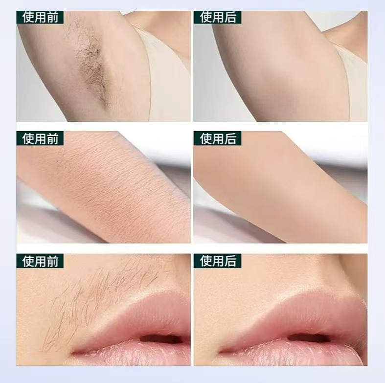 New Body Bikini IPL 500,000 Fl - đánh giá và giá Industrial Laser Cleaning Machine